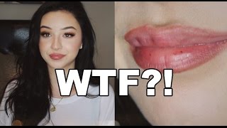 The TRUTH About Lip Injections [upl. by Wilkey]