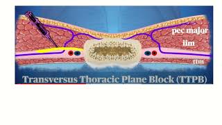 Anatomy of Intercostal Nerve Block A Comprehensive Guide [upl. by Yelad]