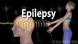 Epilepsy Types of seizures Symptoms Pathophysiology Causes and Treatments Animation [upl. by Powel]