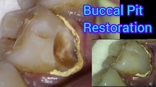 Deep Buccal Pit Restoration under Dental Operating Microscope  Composite Filling of Buccal Cavity [upl. by Odlanar]