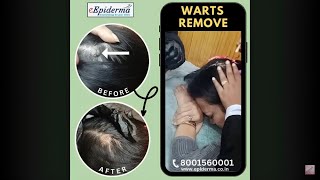 Big Head Wart Removal  Unleashing The Ultimate Method  wartstreatment skincare [upl. by Corry310]