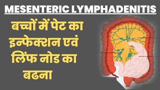 MESENTRIC LYMPHADENITIS in Hindi । बच्चों में पेट का इन्फेक्शन । लिंफ नोड का बढना [upl. by Desirae]