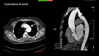 Imaging in Phakomatosis [upl. by Yelnet]