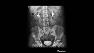 IVPIntravenous pyelogram [upl. by Parrish]