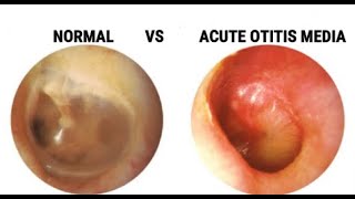 Acute Otits Media vs Normal Ear and More [upl. by Darrel]