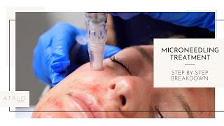 Microneedling I Facial Rejuvenation I StepByStep [upl. by Durnan]