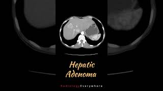 Hepatic adenoma  Hepatocellular Adenoma  Radiology Everywhere   USS  CT  MRI [upl. by Popele30]