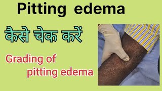 Pitting edema How to examine pitting edema Grades in pitting edema [upl. by Winebaum]