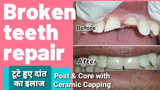 Broken teeth repair  Front teeth ceramic capping  टूटे हुए दांत का इलाज  Post amp Core build up [upl. by Aramanta]