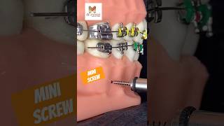 Mini Screw Dental Braces  Orthodontics [upl. by Pax]