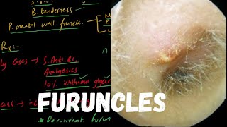 FURUNCLE  Localized Acute Otitis Externa [upl. by Aldous]