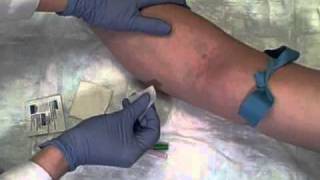 Phlebotomy on Live Patient Straight Needle [upl. by Nnaeirrac803]