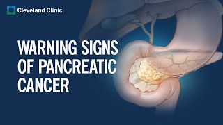 6 Warning Signs of Pancreatic Cancer [upl. by Nilyahs]