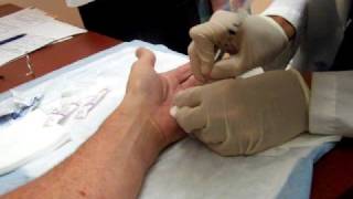 Dupuytrens Contracture  8 minute Cure [upl. by Aillij]