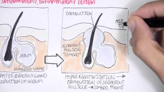 Acne Pathophsyiology [upl. by Rina]