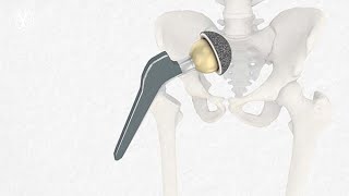 Implantation einer Hüftgelenk Endoprothese und Leben mit einem künstlichen Hüftgelenk [upl. by Erbma]