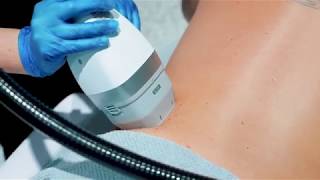 LIPOcel Body Sculpting [upl. by Faubert]