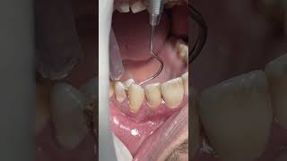 Dental problem of food impacts in deep caries dentist [upl. by Ochs]