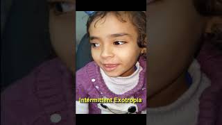 Intermittent Exotropia [upl. by Millur]