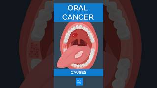 Oral cancer Causes  Kenhub oralcancer [upl. by Evilc178]