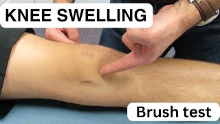 Knee Swelling  The Brush Test [upl. by Zacharie]