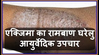 Health Tips एक्जिमा का रामबाण घरेलु आयुर्वेदिक उपचार  Charm Rog  Eczema ka Gharelu Upchar [upl. by Zeralda]