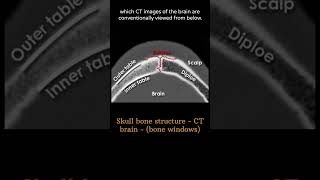 Skull bone structure 2 CT Brain Anatomy Skull Bones amp Sutures radiologychannel007 [upl. by Seaton]