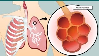 COPD and emphysema [upl. by Aihtnic]