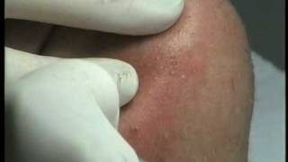 Electrolysis treatment of chin hairs [upl. by Nelaf698]