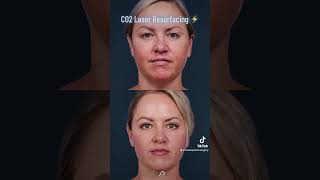 Revitalize Your Skin with CO2 Laser Resurfacing  The Ultimate Solution for Wrinkles and Scars [upl. by Inglebert]