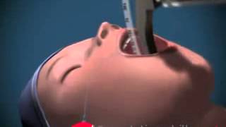 Endotracheal Intubation Animated [upl. by Houser]