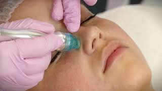 Hydrodermabrasion Facial [upl. by Lorrin]