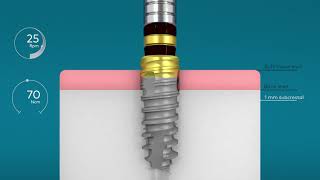 Mucointegration and subcrestal placement of a Nobel Biocare N1™ implant [upl. by Coral]