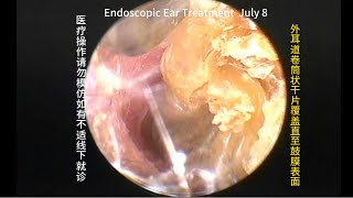 Ear blockage and removal of foreign objects [upl. by Reivaj]