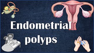 Endometrial Uterine Polyps  Everything You Need To Know [upl. by Ginnifer]