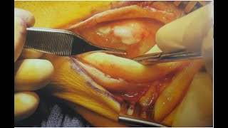 Ankle Injury 2C Peroneal Tendon Repair with Images [upl. by Nageek]