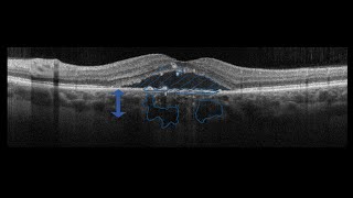 Course in clinical applications of OCT for macular diseases  Pachychoroid [upl. by Airaet241]