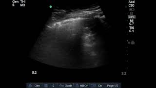 Pneumonia lung [upl. by Gensler656]