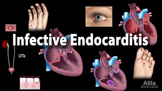 Infective Endocarditis Animation [upl. by Beulah725]