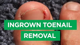 Ep 59 Ingrown Toenail Removal Procedure  The Scope [upl. by Xenia995]