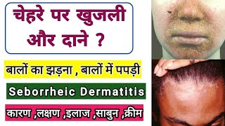 बाल झड़ना और  Seborrheic dermatitis  Hair Falling  Symptoms  causes Treatment  Dr tarun [upl. by Hattie]