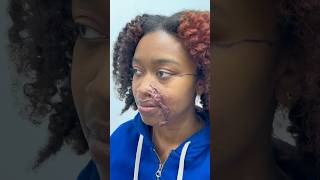 Keloid Removal For Acid Attack Survivor plasticsurgery [upl. by Chemosh937]