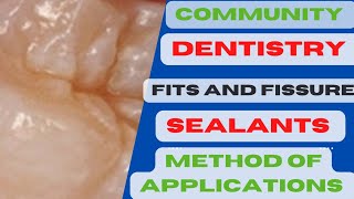 Method of Sealent ApplicationPits and fissure sealants procedurePits and fissure sealants in Hindi [upl. by Bishop]