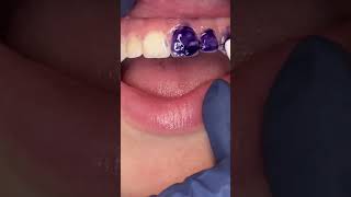 Color Correcting Purple ToothPastedoes it work [upl. by Demahom]