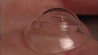 Scleral Contact LensesMayo Clinic [upl. by Daveda]