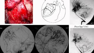 Surgical Treatment of Juvenile Patients with Moyamoya DiseaseHemodynamic Measurement [upl. by Amaleta546]