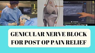 Ultrasound guided genicular nerve block for knee osteoarthritis in Chennai [upl. by Llovera]