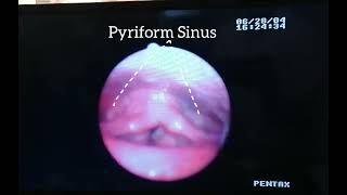 Nasopharyngolaryngoscopy NPL showing Vocal cord polyp and Reinke’s edema [upl. by Acyre]