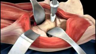 Hip replacement surgery techniques  Dr Scott Devinney [upl. by Ahsiuqet234]