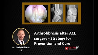 Arthrofibrosis Stiff Knee after ACL surgery  Strategy for Prevention and Cure Dr Andy Williams [upl. by Azilem345]